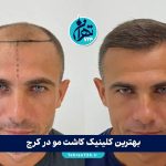 بهترین کلینیک کاشت مو در کرج 1405 | معرفی ۶ مرکز برتر با آدرس، خدمات و شماره تماس