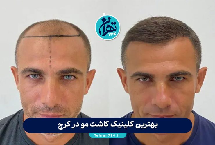 بهترین کلینیک کاشت مو در کرج 1405 | معرفی ۶ مرکز برتر با آدرس، خدمات و شماره تماس