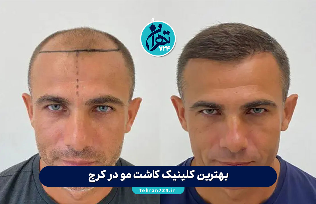 بهترین کلینیک کاشت مو در کرج 1405 | معرفی ۶ مرکز برتر با آدرس، خدمات و شماره تماس