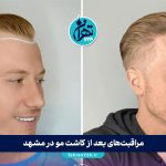 مراقبت‌های بعد از کاشت مو در مشهد + معرفی بهترین کلینیک‌های کاشت مو و ابرو