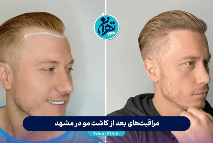 مراقبت‌های بعد از کاشت مو در مشهد + معرفی بهترین کلینیک‌های کاشت مو و ابرو