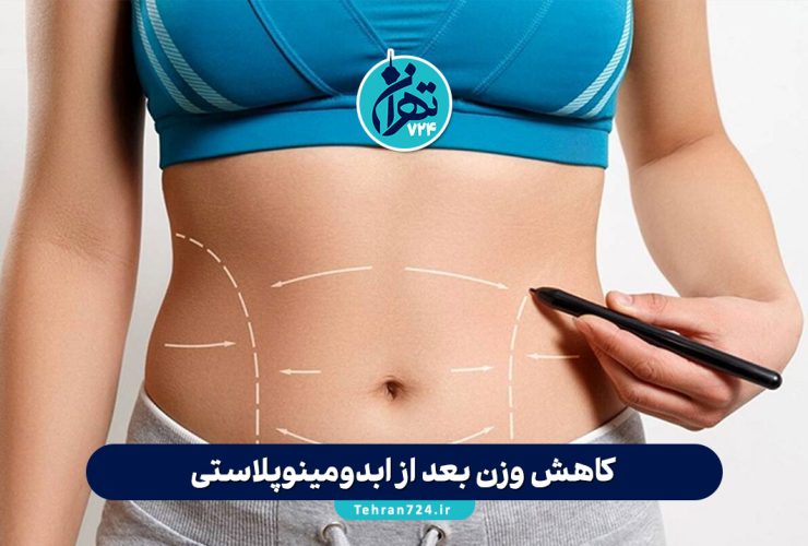 کاهش وزن بعد از ابدومینوپلاستی؛ رازهای رسیدن به شکم صاف و نکات مهم قبل و بعد از عمل