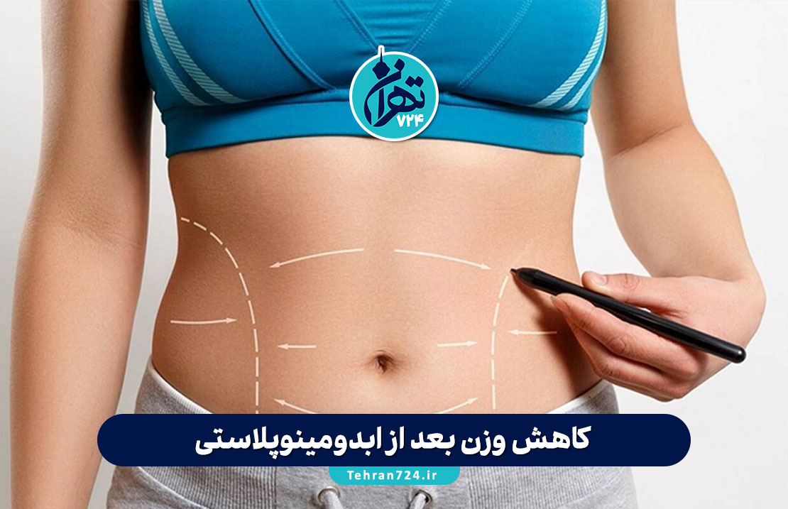 کاهش وزن بعد از ابدومینوپلاستی؛ رازهای رسیدن به شکم صاف و نکات مهم قبل و بعد از عمل