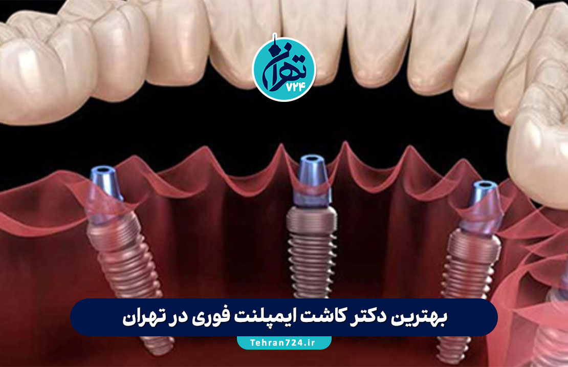 بهترین دکتر کاشت ایمپلنت فوری در تهران | معرفی 8 متخصص برتر + آدرس و شماره تماس