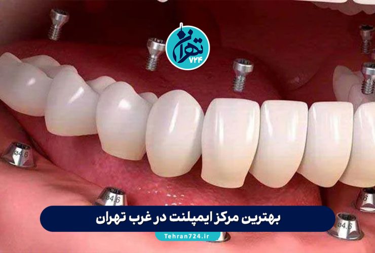 بهترین مرکز ایمپلنت در غرب تهران ✔️ معرفی 5 کلینیک معتبر با آدرس و خدمات 1405