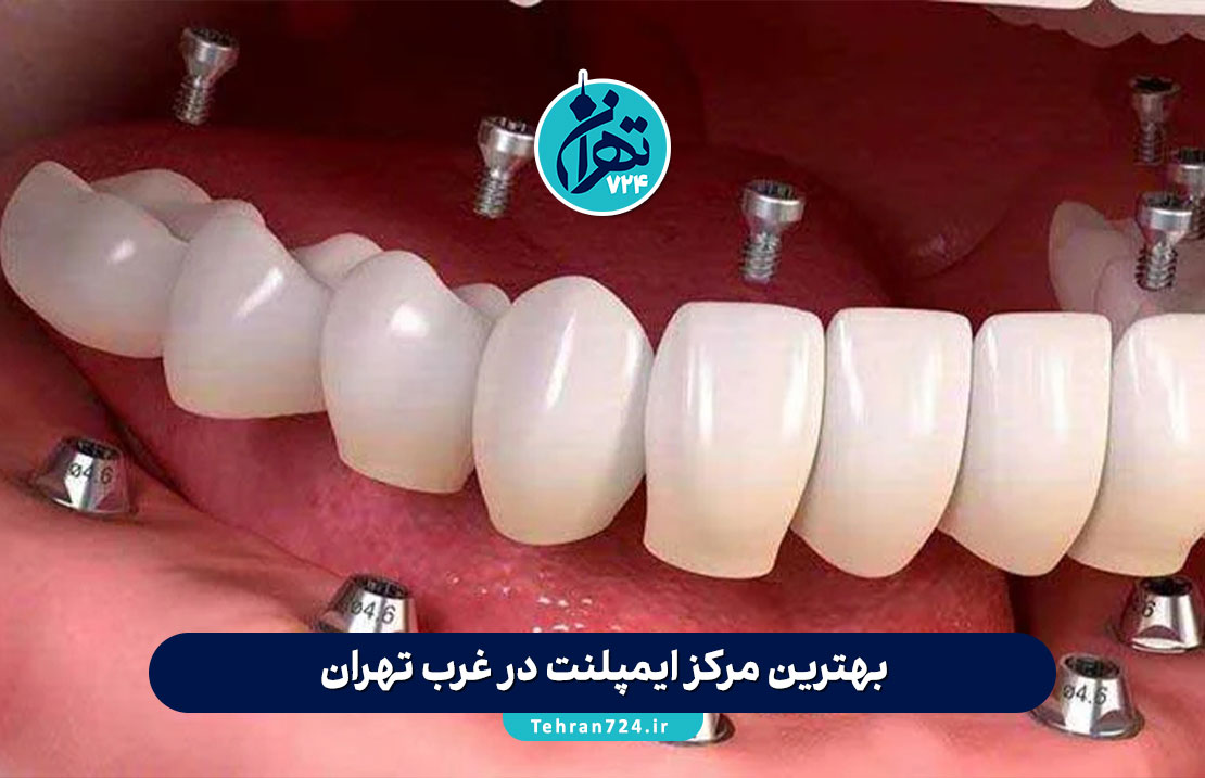 بهترین مرکز ایمپلنت در غرب تهران ✔️ معرفی 5 کلینیک معتبر با آدرس و خدمات 1405